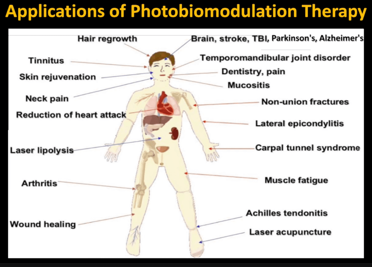 Drawing of human body showing various medical conditions that PBM can help